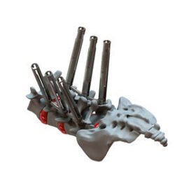 minimally invasive pedicle screw positioning systemATHENA