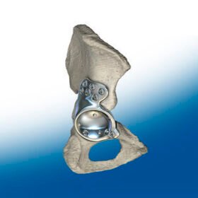 revision acetabular prosthesis