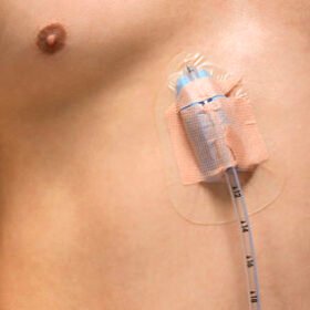 wound drainage catheter catheter fixationPleura-Guard