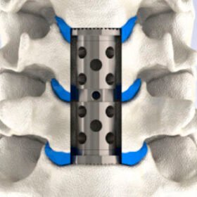 cervical vertebral corpectomy prosthesisLEANDER®
