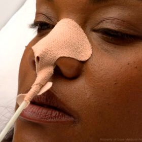 nasogastric tube catheter fixation160