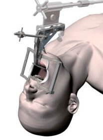 right-angle pharyngoscopeSatou