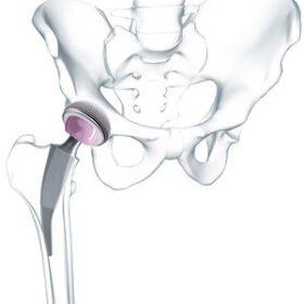 minimally invasive hip prosthesisMetha®