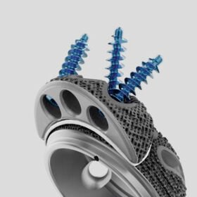 revision acetabular prosthesisStructan®