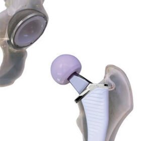 primary hip prosthesisCordera™