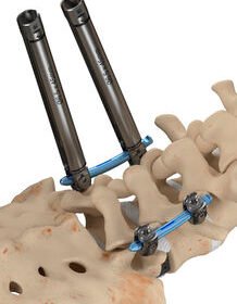 minimally invasive pedicle screw positioning systemInvictus™
