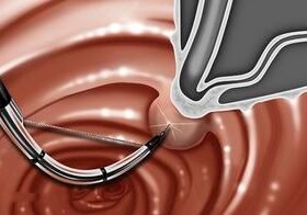 biliary sphincterotomy sphincterotomeGTOME®