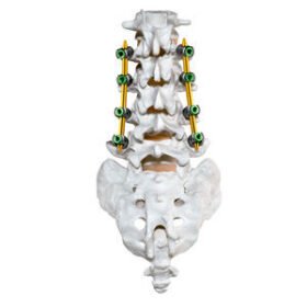 minimally invasive pedicle screw positioning systemCREO MIS®